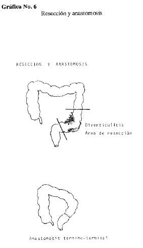 Resección y anastomosis