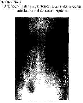 Arteriografia de la mesenterica