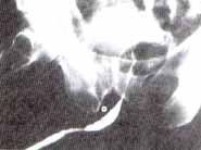 vu-113- Figura 6a Cistouretografia miccional de la uretra
