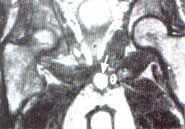 Próstata (p) dislocada hacia el lado derecho