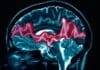 El TDAH retrasa el desarrollo de ciertas áreas del cerebro