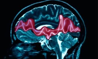 El TDAH retrasa el desarrollo de ciertas áreas del cerebro