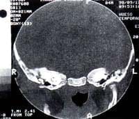 Tomografía Axial Computarizada de hueso temporal a nivel Mastoides