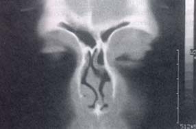 Tomografía con celdilla Aggeriana gigante desviando la lámina perpendicular
