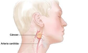 Paragangliomas