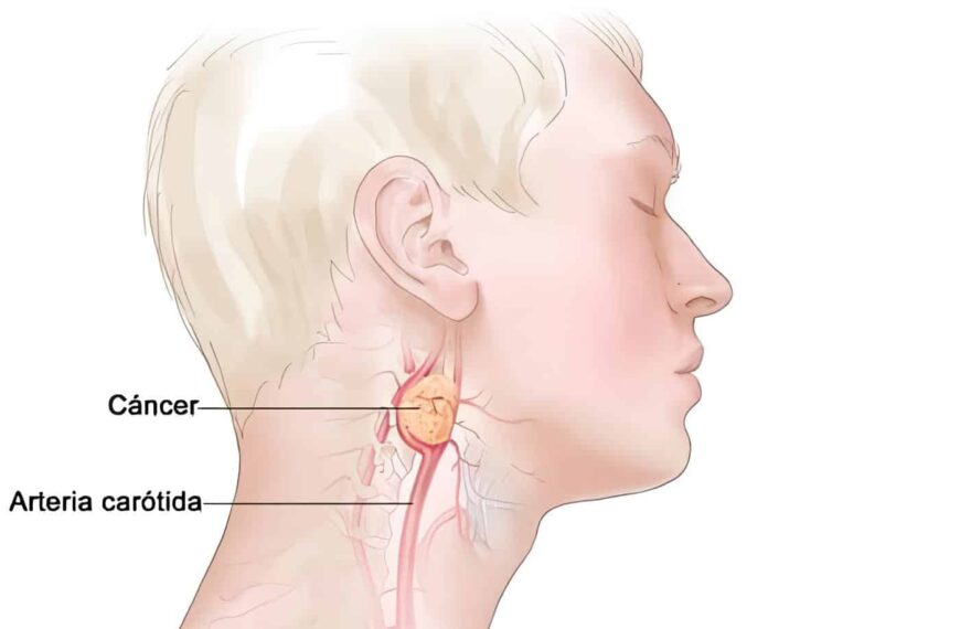 Paragangliomas