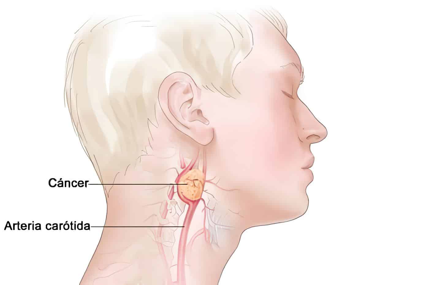 Paragangliomas