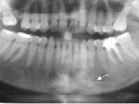 Aspecto radiológico de la mandíbula de una paciente con Síndrome Sapho