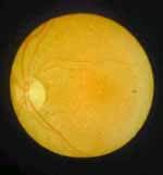 Maculopatía en ojo de buey