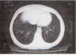 TAC de tórax que muestra múltiples opacidades nodulares de 1 a 4 mm de diámetro de densidad cálcica dispersas en todo el parénquima pulmonar