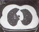 TAC de tórax que muestra múltiples opacidades nodulares de 1 a 4 mm de diámetro de densidad cálcica dispersas en todo el parénquima pulmonar2