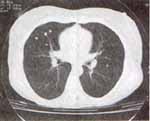 TAC de tórax que muestra múltiples opacidades nodulares de 1 a 4 mm de diámetro de densidad cálcica dispersas en todo el parénquima pulmonar3