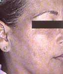 Pigmentación macular difusa en la cara