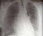 Radiografía de tórax PA. Se visualiza quiste gigante en área de base pulmonar izquierda.