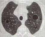 Tomografía axial computarizada (TAC) pulmonar. Se aprecian múltiples quistes en el parénquima pulmonar de diferentes tamaños.