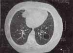 Tomografía axial computarizada (TAC) pulmonar. Se observan múltiples quistes pulmonares, con uno de mayor tamaño en hemitórax izquierdo.