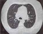 Tomografía axial computarizada (TAC) pulmonar. Múltiples quistes pulmonares, con algunos orientados hacia pared pleural.