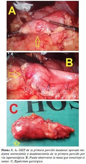  A. GIST de la primera porción duodenal operado mediante antrectomía y duodenectomía de la primera porción por vía laparoscópica. B. Puede observarse la masa que constituye el tumor. C. Espécimen quirúrgico.