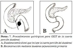 . Procedimientos quirúrgicos para GIST de la cuarta porción duodenal A. Duodenectomía distal que incluye la cuarta porción del duodenal B. Reconstrucción mediante duodeno-yeyunostomía primaria