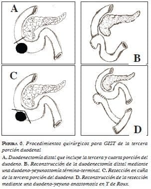 Procedimientos quirúrgicos para GIST de la tercera porción duodenal A. Duodenectomía distal que incluye la tercera y cuarta porción del duodeno.