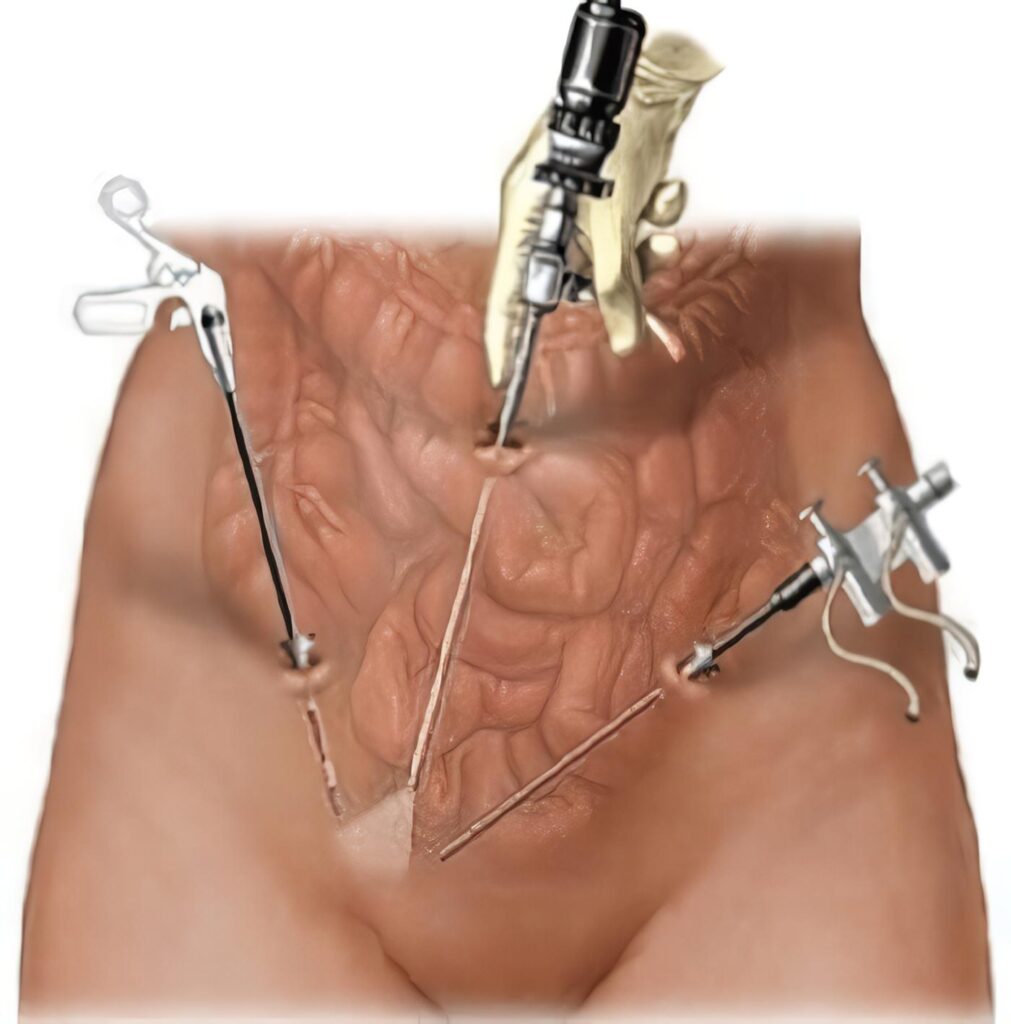 Ureterolitotomia Endoscopica