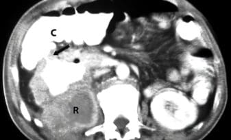 Fístula Renocólica de Diagnóstico Tardío Post-Nefrolitotomía Percutánea