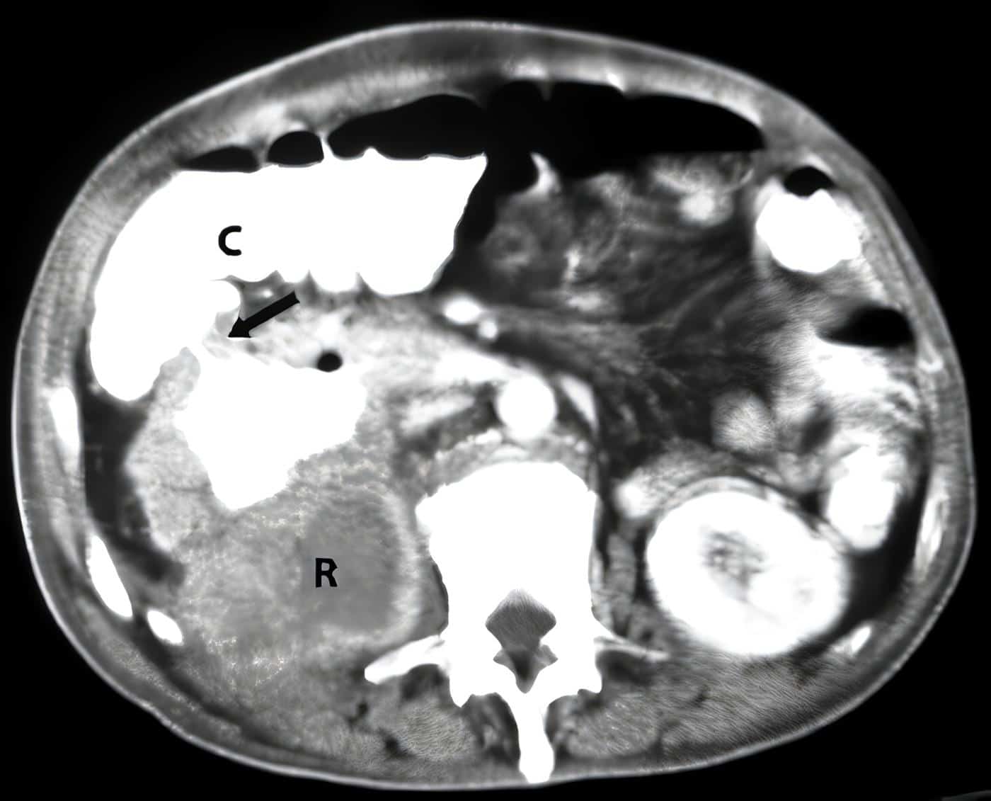 Fístula Renocólica de Diagnóstico Tardío Post-Nefrolitotomía Percutánea