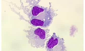 Reporte de Casos en Ureterocistoplastia