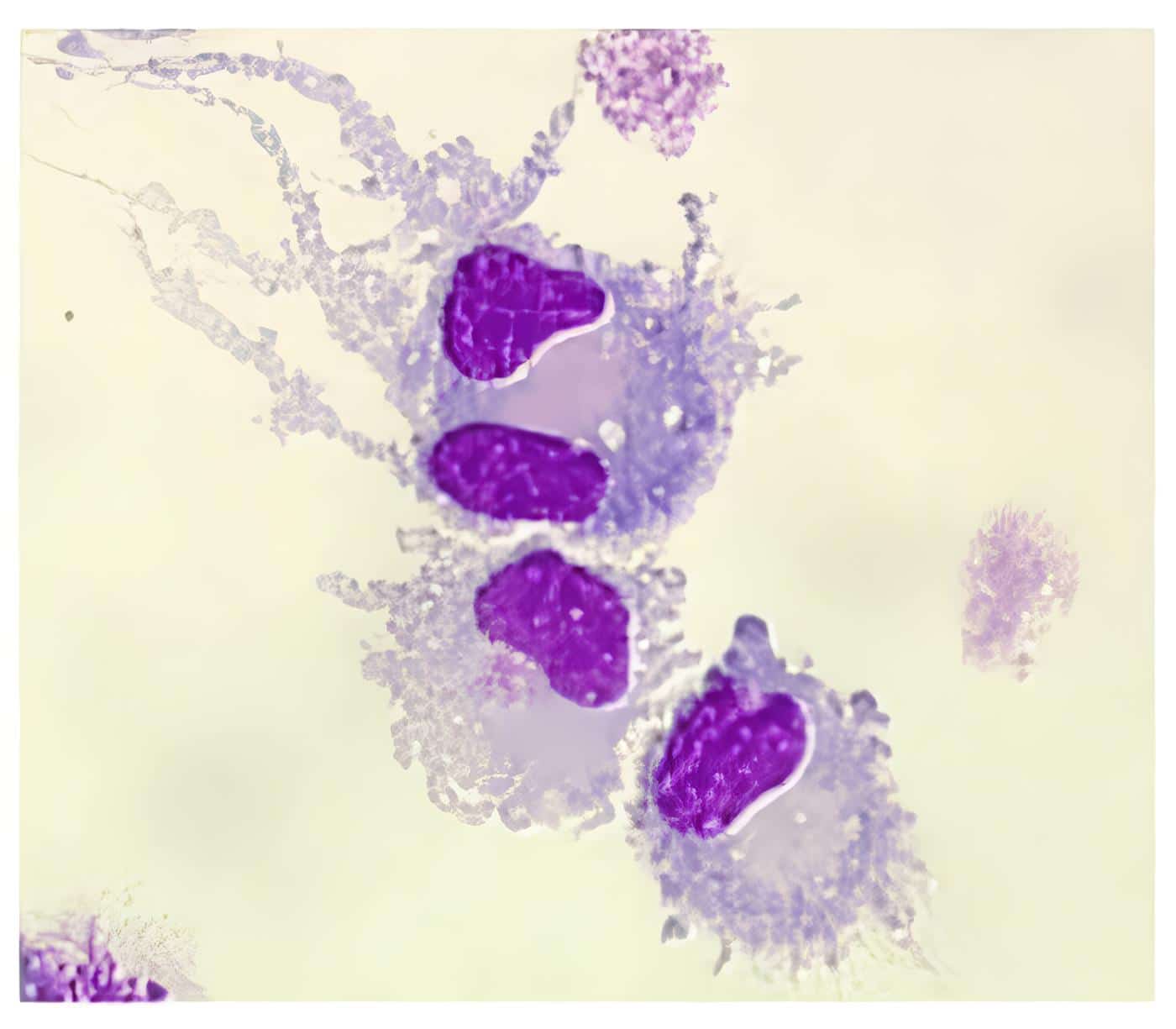 Reporte de Casos en Ureterocistoplastia