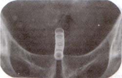 Radiografía de Stent implantado en uretra prostática