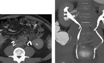 Ureterocele Esfintérico Refluyente