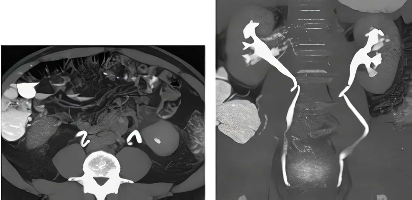 Ureterocele Esfintérico Refluyente