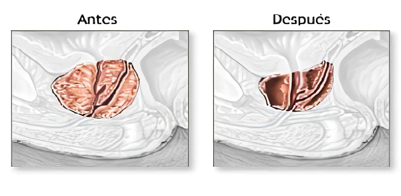 Ureterocistoplastia en el Hospital de la Misericordia