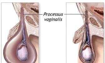 Poster: Dispositivos Intrauterinos como causa de Litiasis Vesical