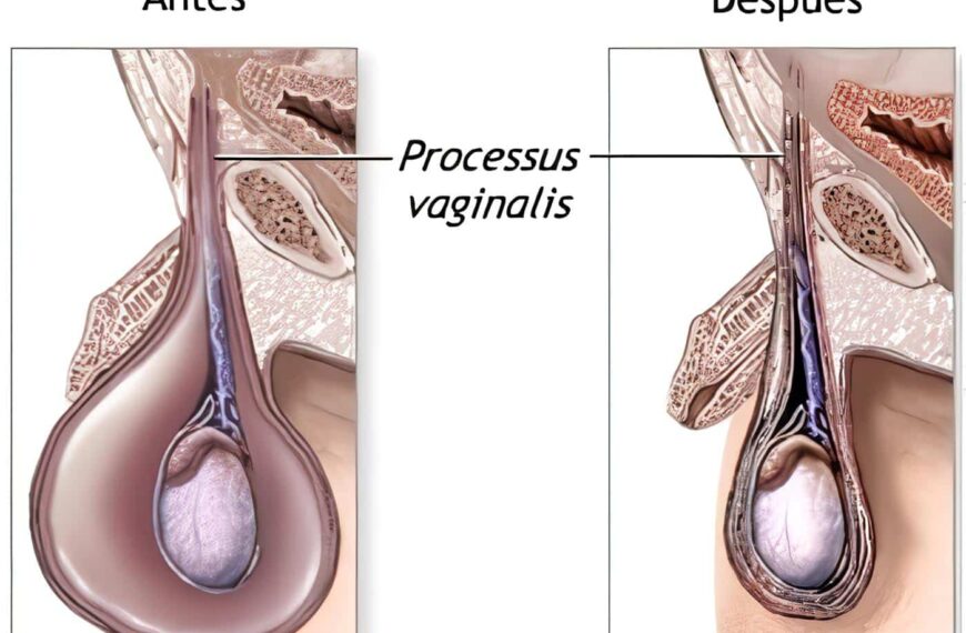 Poster: Dispositivos Intrauterinos como causa de Litiasis Vesical