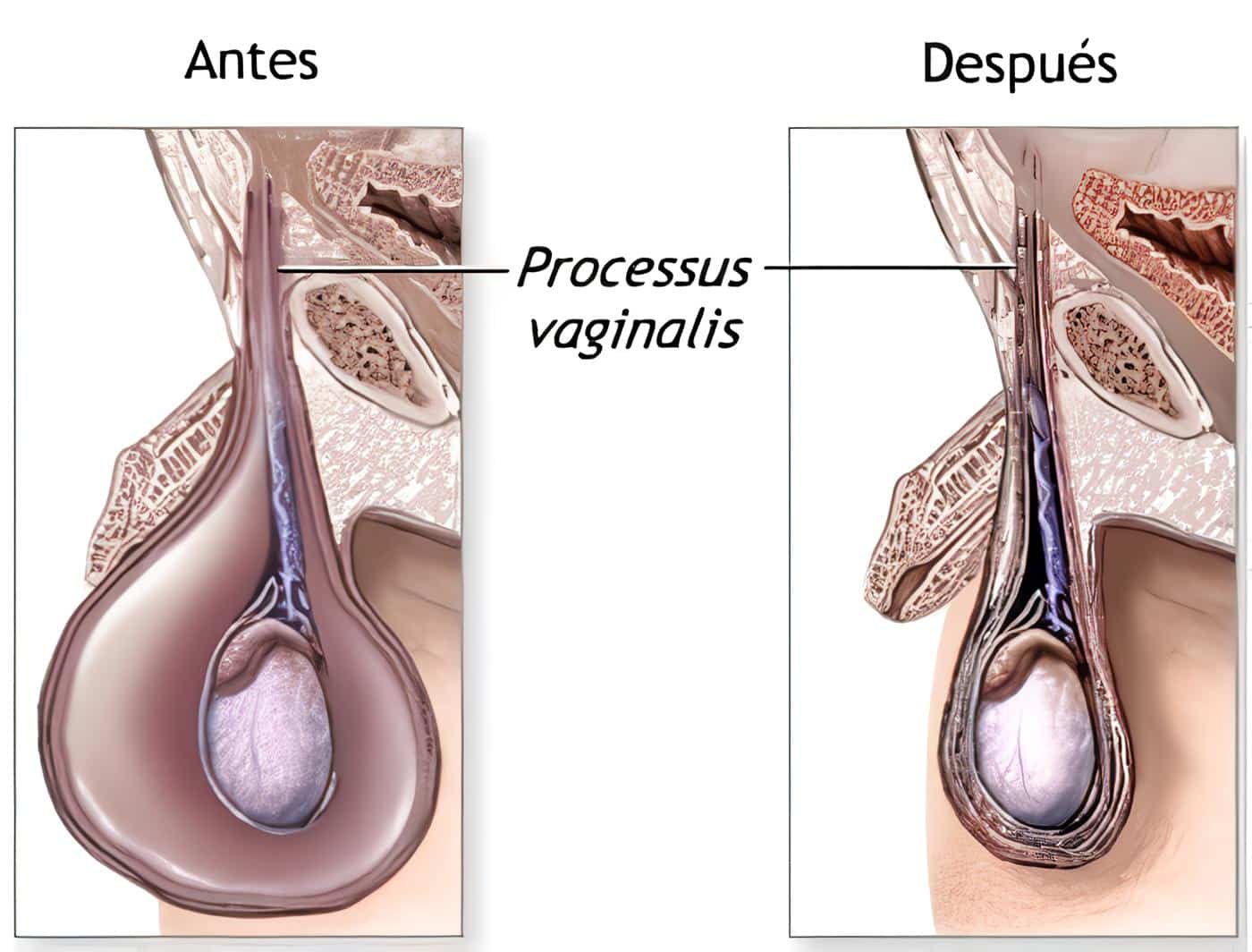 Poster: Dispositivos Intrauterinos como causa de Litiasis Vesical