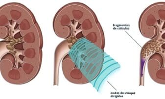 Uso de Catéteres Ureterales en Pacientes con Cálculos Renales Grandes y Ureterales Durante L.E.C.