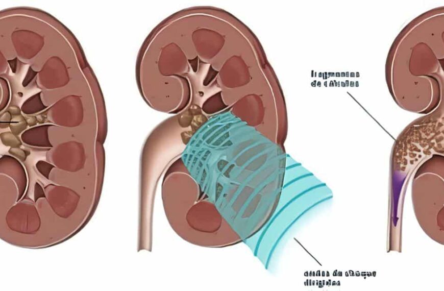 Uso de Catéteres Ureterales en Pacientes con Cálculos Renales Grandes y Ureterales Durante L.E.C.