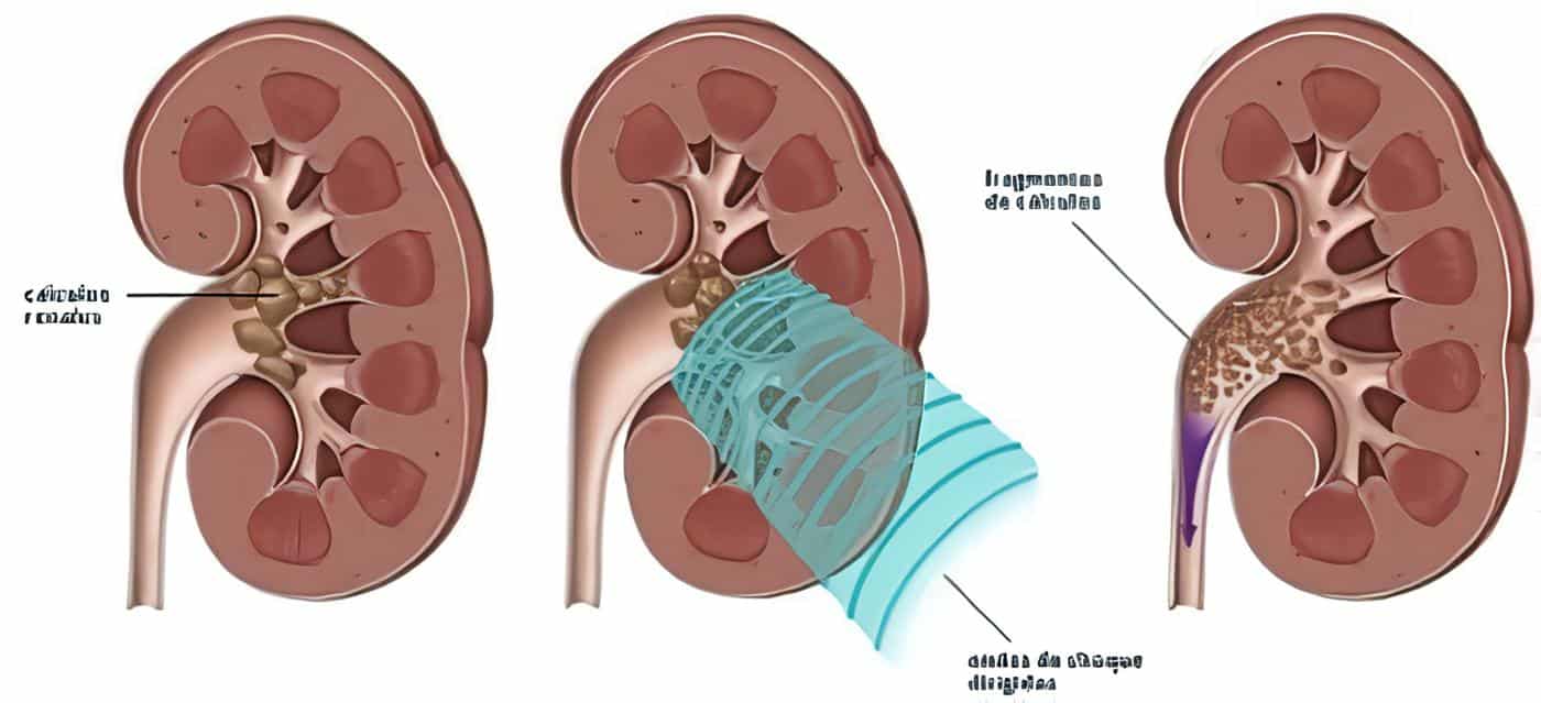 Uso de Catéteres Ureterales en Pacientes con Cálculos Renales Grandes y Ureterales Durante L.E.C.