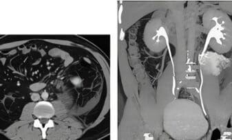 Ureter Retrocavo Tipo I