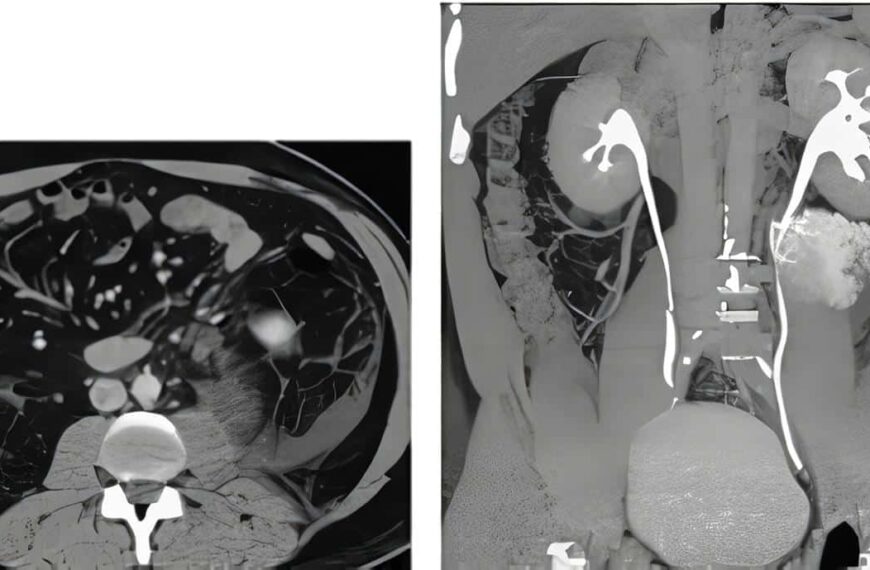 Ureter Retrocavo Tipo I