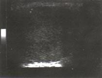 Ultrasonografía de testícular con escasas imágenes ecogénicas