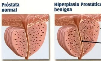 Obstrucción Urinaria Sintomática por Hipertrofia Prostática Benigna (H.P.B.)