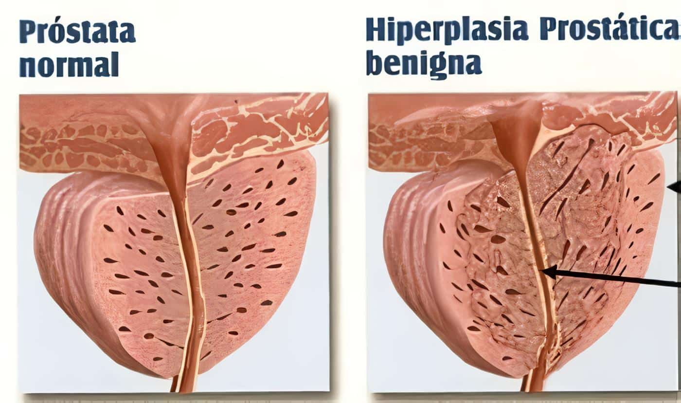 Obstrucción Urinaria Sintomática por Hipertrofia Prostática Benigna (H.P.B.)