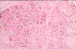 Aspecto del páncreas con extensa fibrosis