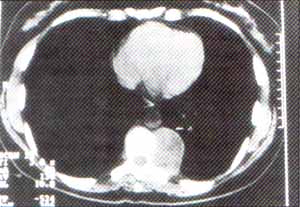 Tac de masa gavabertebral izquierda