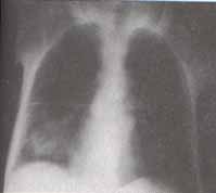 Radiografía de tórax. Consolidación basal derecha