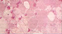 Corte microscópico del pulmón  llenamiento alveolar por material proteináceo PAS (+)