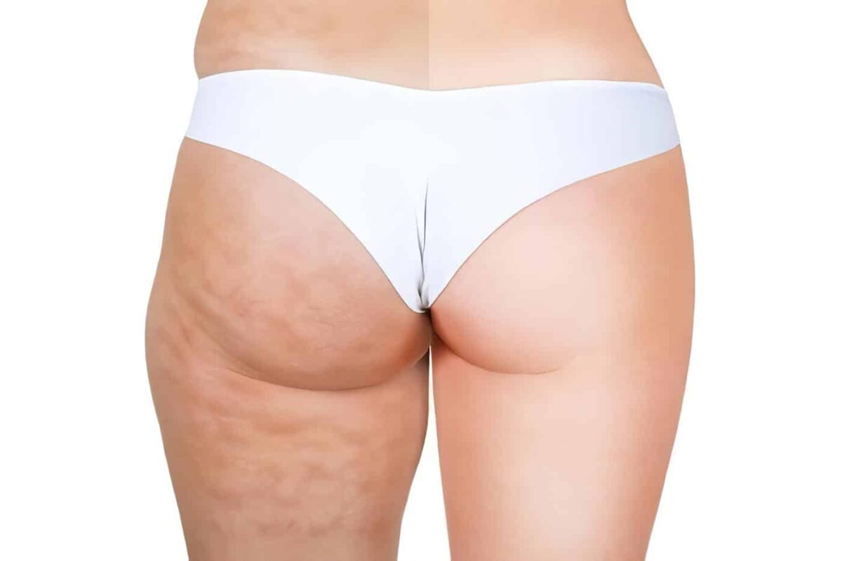 Clases de celulitis