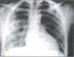 Radiografía PA, vertical con traumatismos tóraco- abdominal